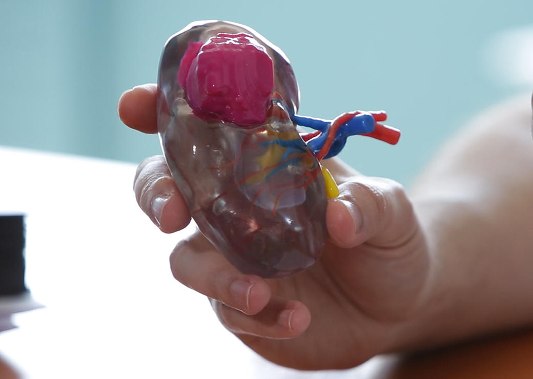 Impression 3D dans le pré opératoire