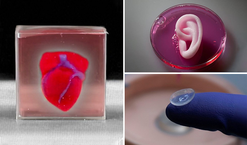 Impression 3D dans le pré opératoire