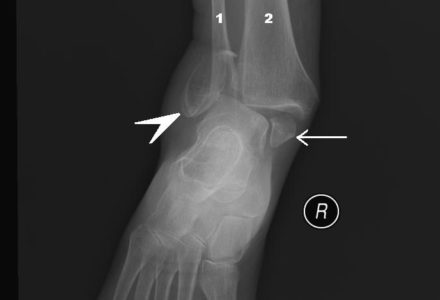 impression 3D et fractures