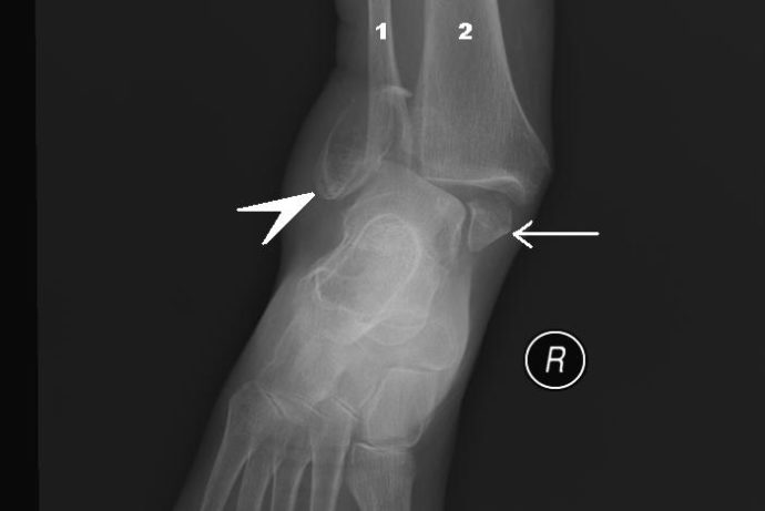 impression 3D et fractures